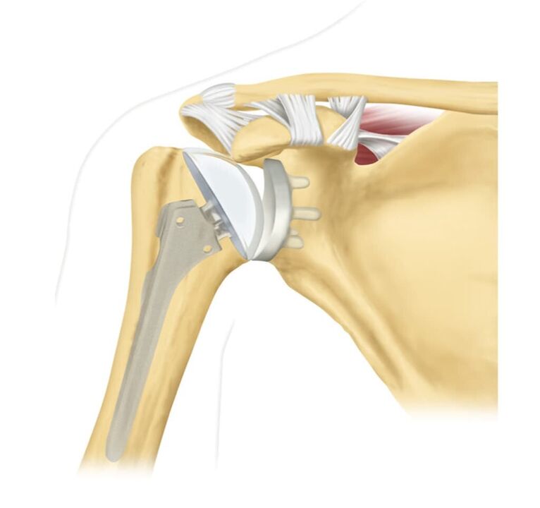 Replacement of a damaged shoulder joint with an endoprosthesis