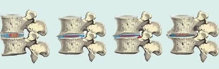 Spinal lesion in thoracic osteochondrosis