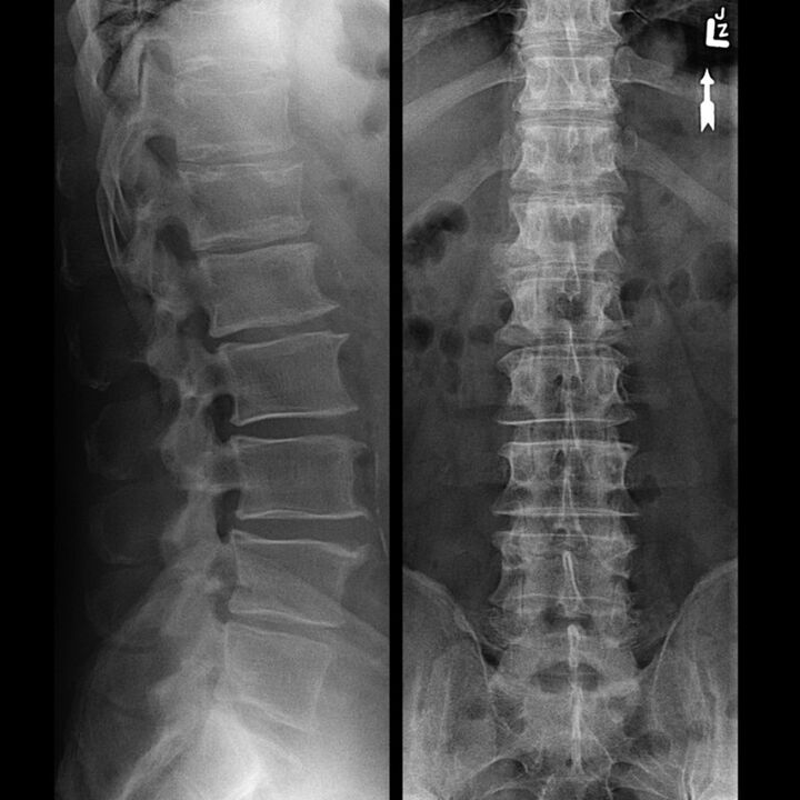 Chest x-ray showing a decrease in the gap between the vertebrae from bottom to top along the spine