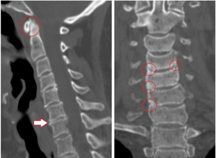 The CT scan shows damaged vertebrae and intervertebral discs of heterogeneous height due to thoracic osteochondrosis