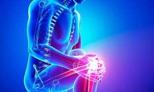 Stages of osteoarthritis of the knee joint