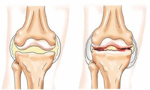 healthy knee joint affected by osteoarthritis