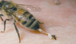 Treatment of hip osteoarthritis by bees