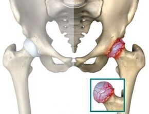 Causes of atrosis of the hip joint