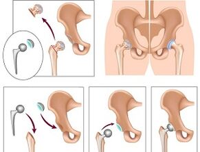 Endoprosthetics for arthrosis of the hip joint