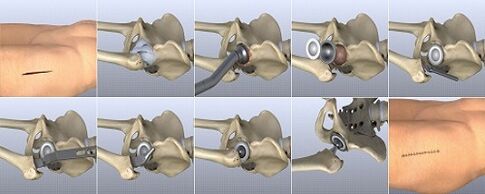 Methods for treating hip osteoarthritis