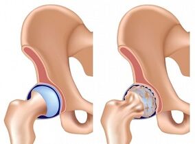 Symptoms of hip osteoarthritis