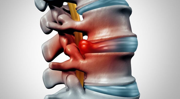 Intervertebral hernia with osteochondrosis